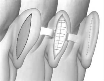 Orejas de soplillo: Corrección de la separación y deformidad del pabellón auditivo por Otoplastia